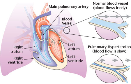 Pulmonary_Hypertension