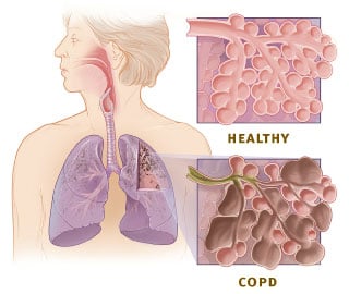 Sings Your COPD is Getting Worse