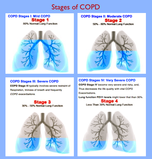 Copd Life Expectancy Chart