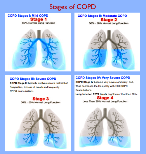 Copd Progression Chart