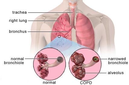 COPD Lungs