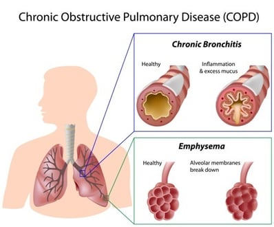 COPD inflammation