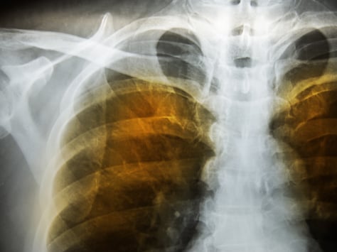 copd lung xray