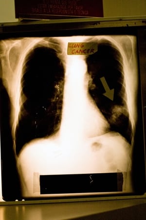 lung cancer in an  x-ray