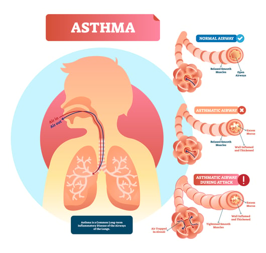 diagram of how asthma works