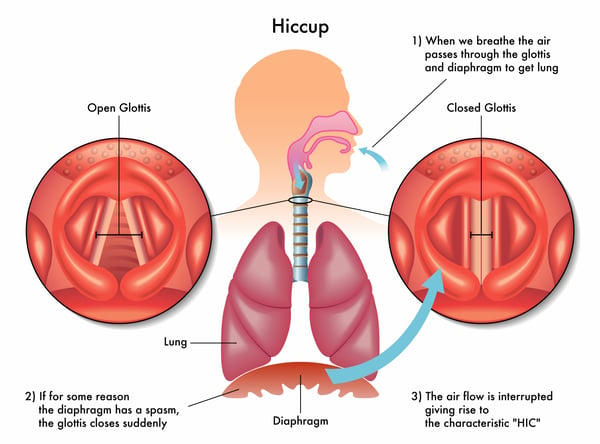 diagram of a hiccup