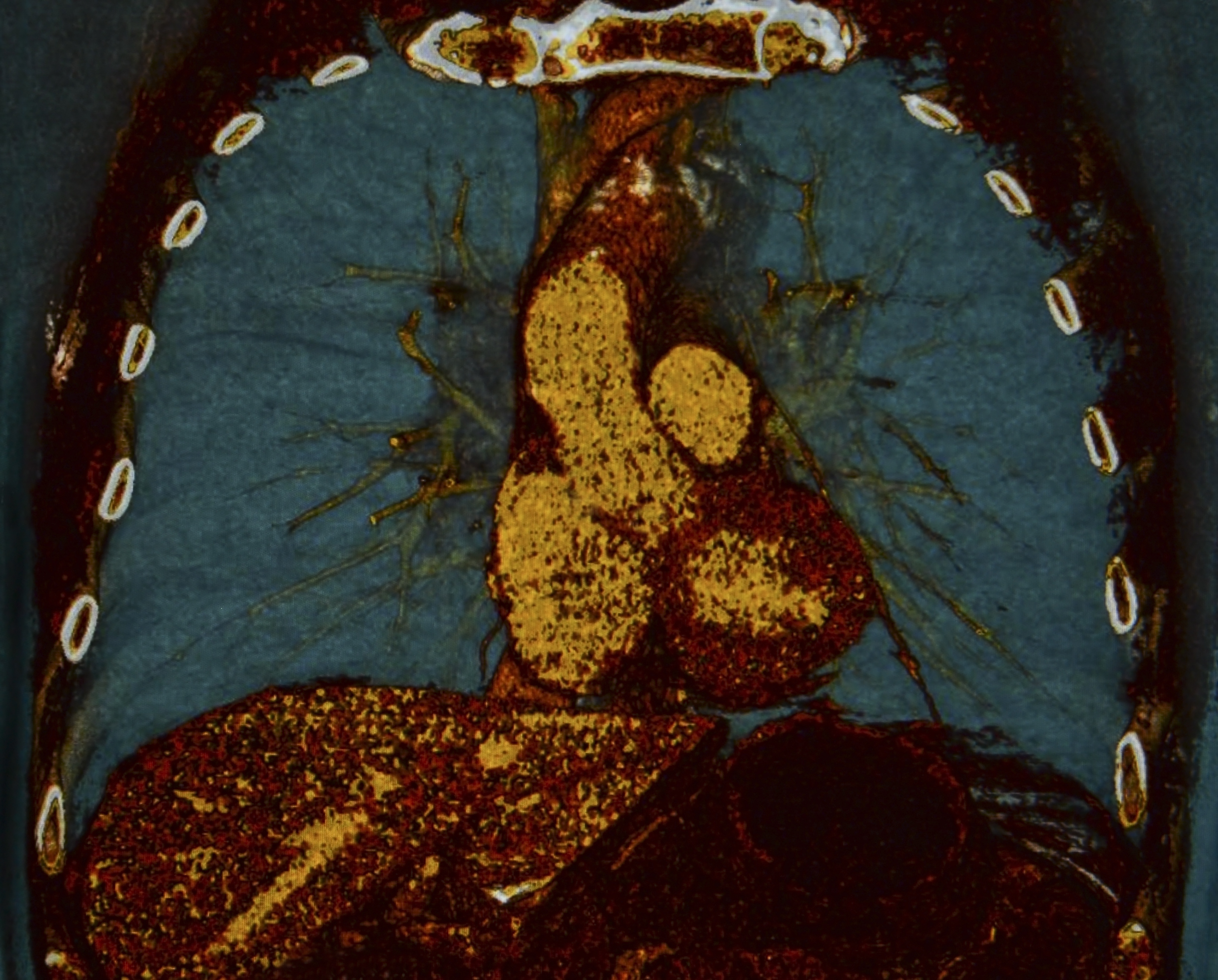 ct scan of the lungs