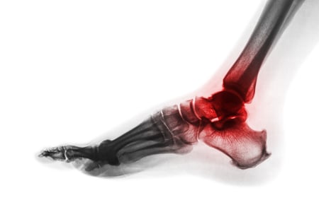 arthritis in ankle
