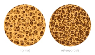 normal osteoporosis.jpg