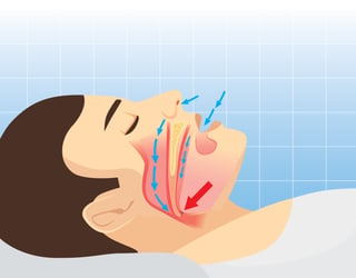 sleep apnea diagram.jpg